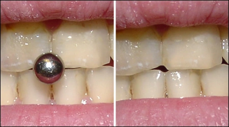 Image: Tooth abrasion