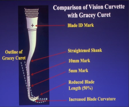 Comparison of Vision Curvette with Gracey Curet