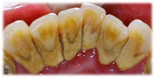 Patient Material - Tartar on Teeth - Image5