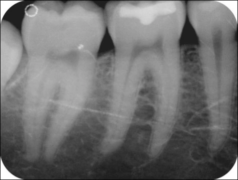 example showing plate receptor scratches