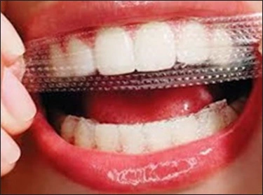 Tooth Whitening - Figure 6
