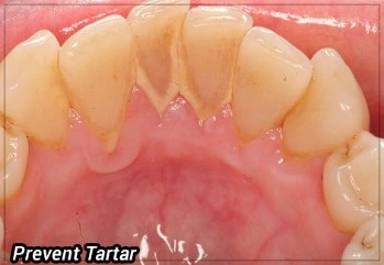 Patient Material - Tartar on Teeth - Image3