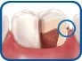  How do you get Cavities? - Image 2
