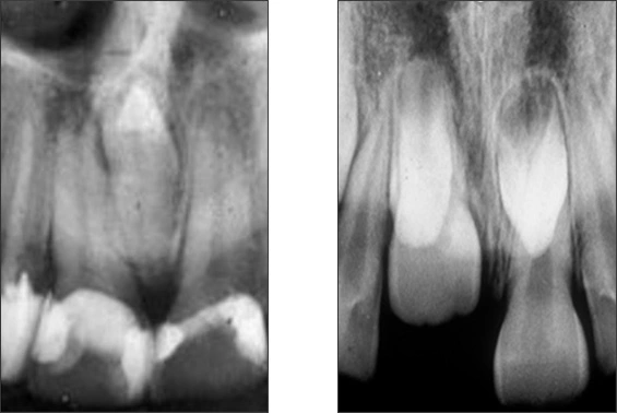 Alterations in the Number of Teeth - Figure 4