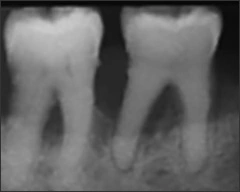 Periapical radiograph of pulpal sclerosis with total obliteration of pulp structures #30