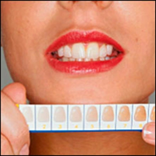 Tooth Whitening - Figure 4