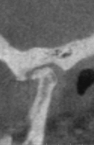 Temporomandibular Joints (TMJs) - Figure 2