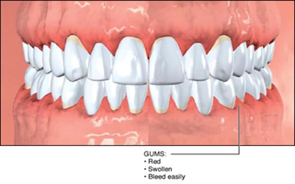 Characteristics of Gingivitis - Figure 1