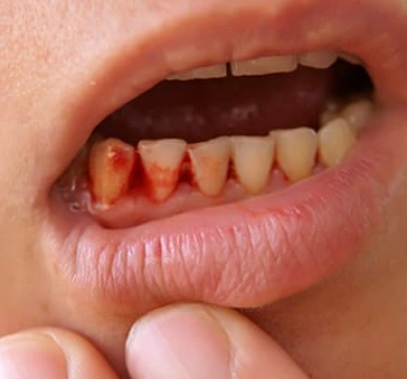 Bleeding Gums 