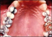 Photo showing dental caries risk.