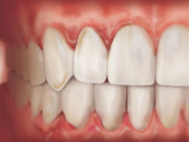 ce542 - Gingivitis Image