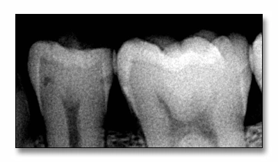 Xray showing an example of mandibular second premolar with a buccal surface cavitation that cannot be remineralized