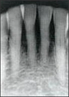 Periapical radiograph of pulpal sclerosis in the mandibular anterior teeth