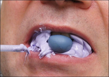 Dental Impressions and Bite Registration - Figure 2