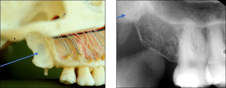 Maxillary Posterior Landmarks - Figure 7