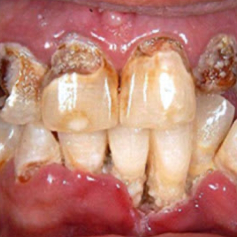 An Introduction to Substance Use Disorders for Dental Professionals