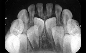 Primary and Permanent Dentition Eruption Sequences - Figure 1