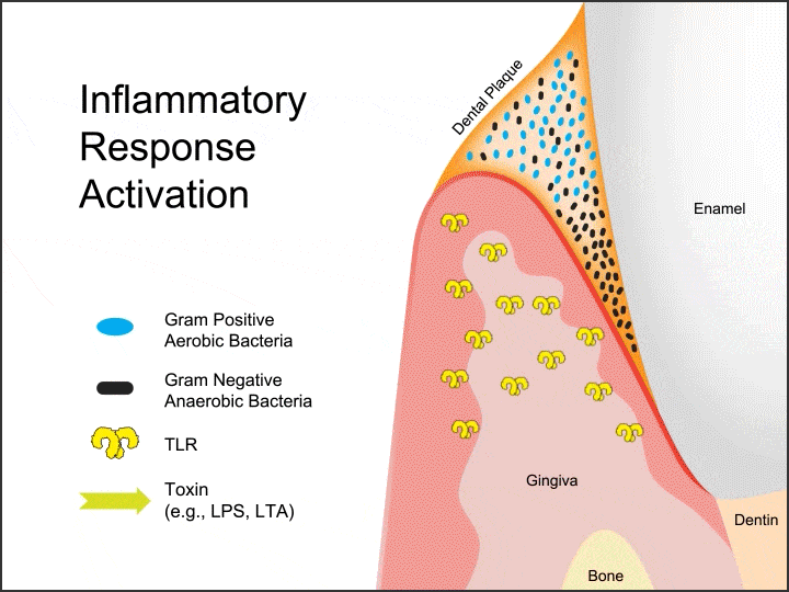 How Gingival Inflammation Develops - Figure 2