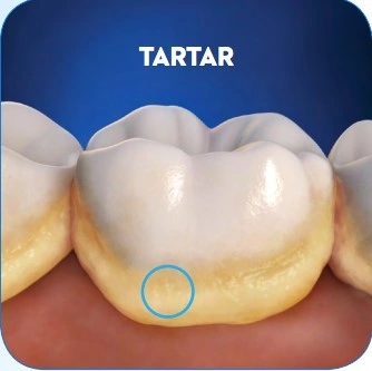 Patient Material - Tartar on Teeth - Image1