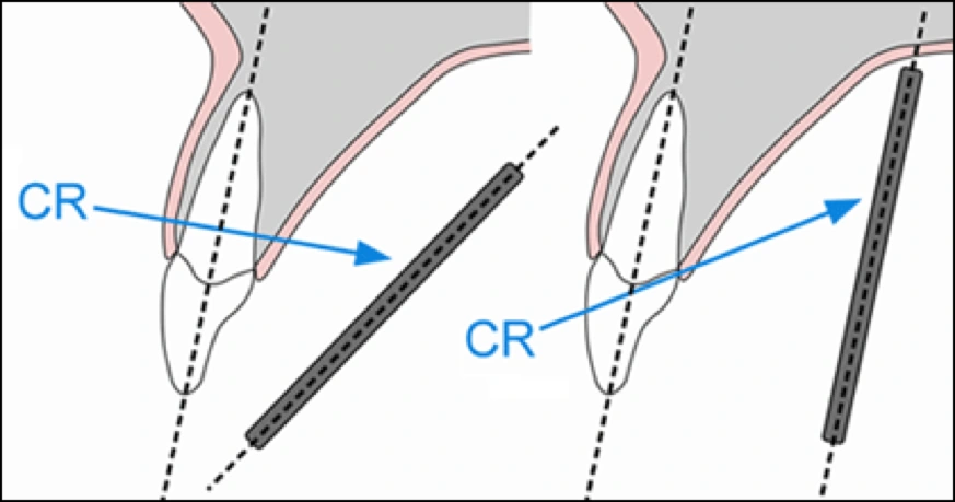 examples of receptor angulation and beam under-angulation