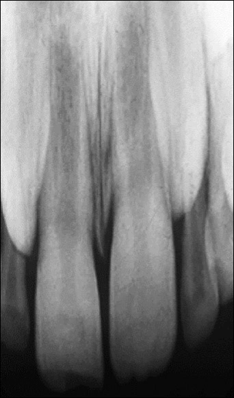 radiographic image showing an example of elongation