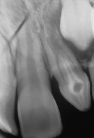 Periapical radiograph of tooth #10 with dens invaginatus Type II