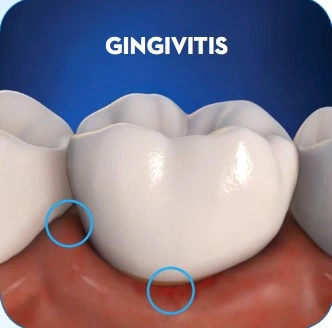 Patient Material - What is Gingivitis? - Image 1