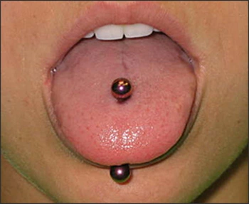 Image: Pierced tongue with jewelry in place.
