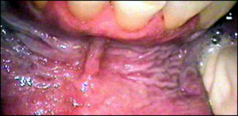 mouth damage from chewing tobacco Oral Implications of Chewing Tobacco Use/Abuse - An Introduction to  Substance Use Disorders for Dental Professionals