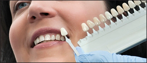 ce542 - Content - Amalgam and Composite Restorations - Figure 1