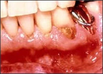 Photo showing dental root caries risk.