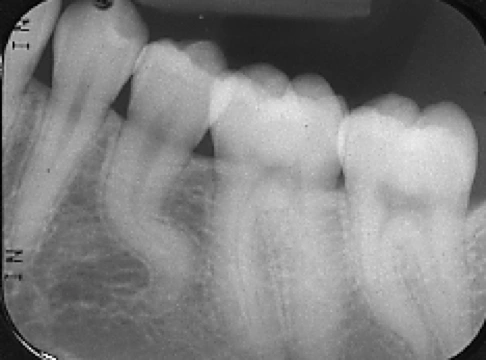 Radiograph showing the receptor not placed perpendicular to the occlusal plane for mandibular teeth.