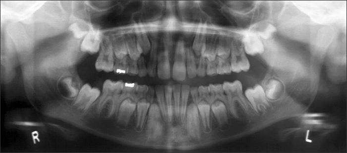 Primary and Permanent Dentition Eruption Sequences - Figure 3