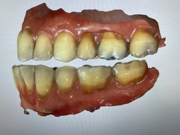 After capturing the protrusive bite at 50-60% of maximum protrusive ability, the software builds a model relating the mandibular arch to the maxillary one. Based on the scans, the dental laboratory can fabricate a mandibular advancement device. 