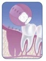 Patient Material - Wisdom Teeth Pain and Removal - Image4