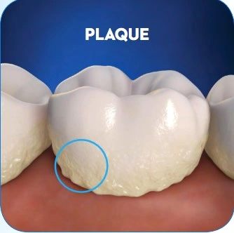 Patient Material - What is Plaque? - Image1