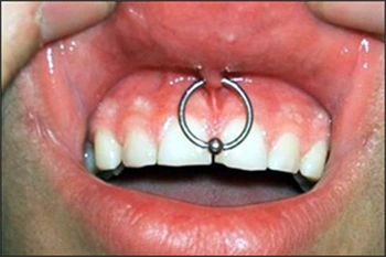 Image: Smiley piercing