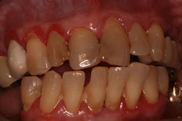 How Gingival Inflammation Develops - Figure 3