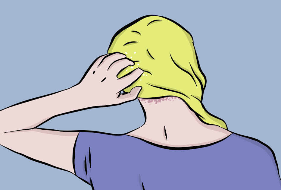 Is It Scalp Psoriasis Or Something Else? The Health Rank