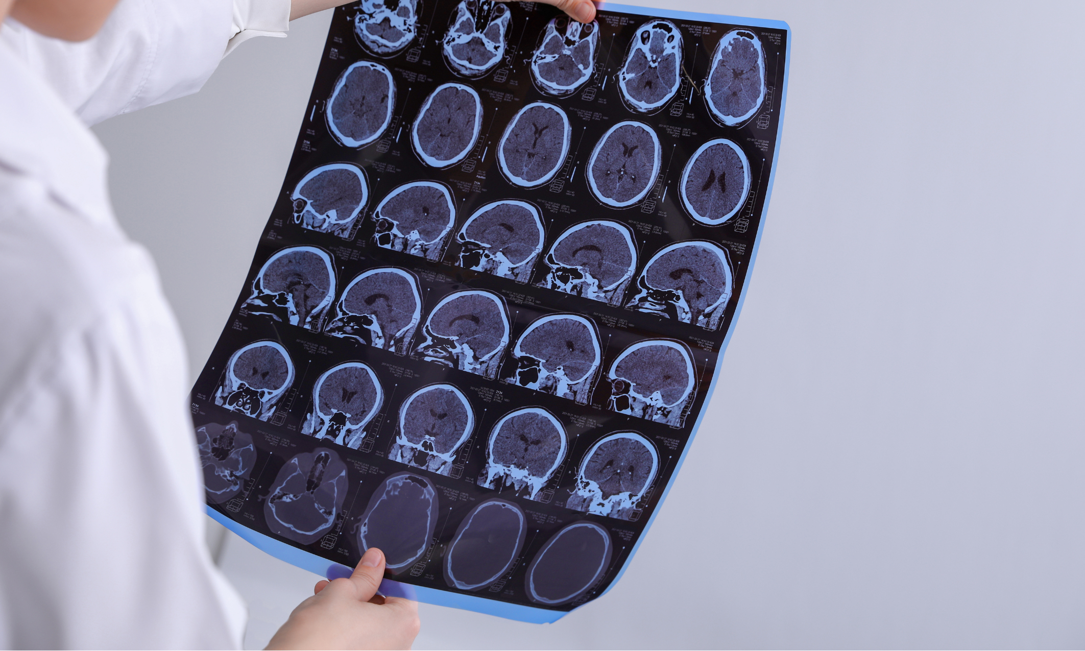 Multiple Sclerosis What Is It And What Can It Do to Your Body? The Health Rank