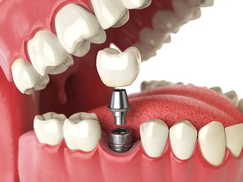 Seniors Here’s What You SHOULD Be Paying for Dental Implants The