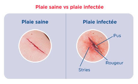 coupure sur une peau normale vs infectée