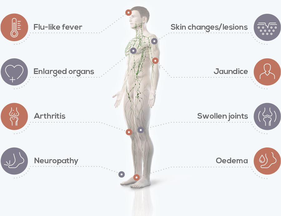 Figure 1: Common signs and symptoms of iMCD (note, not all iMCD patients will present all of these symptoms