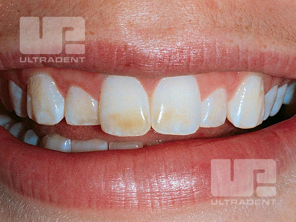 opalescence carbamide peroxide teeth whitening