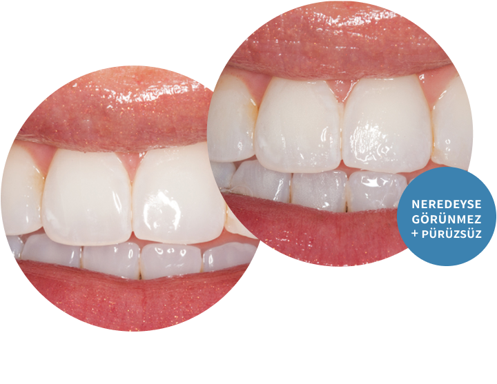 Enamelast Flouride Varnish before and after