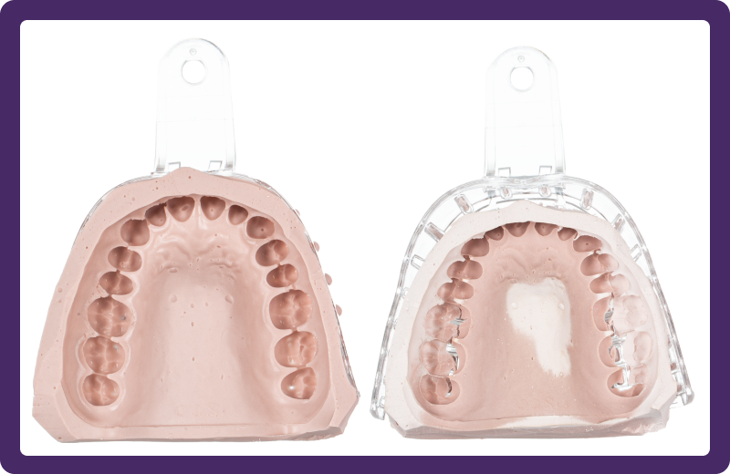 Alginate Competitor Impression After 24 Hours