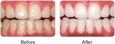 Opalescence Boost Clinical