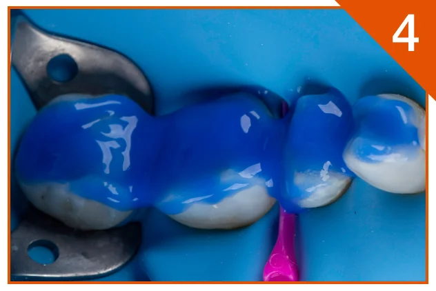 Ultra-Etch used with the total-etch method