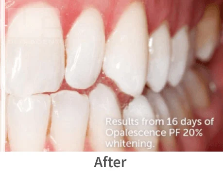 Opalescence whitening after