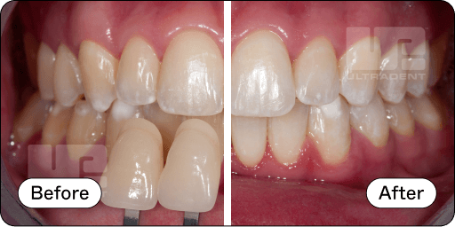 Opalescence Pro Before and After 3